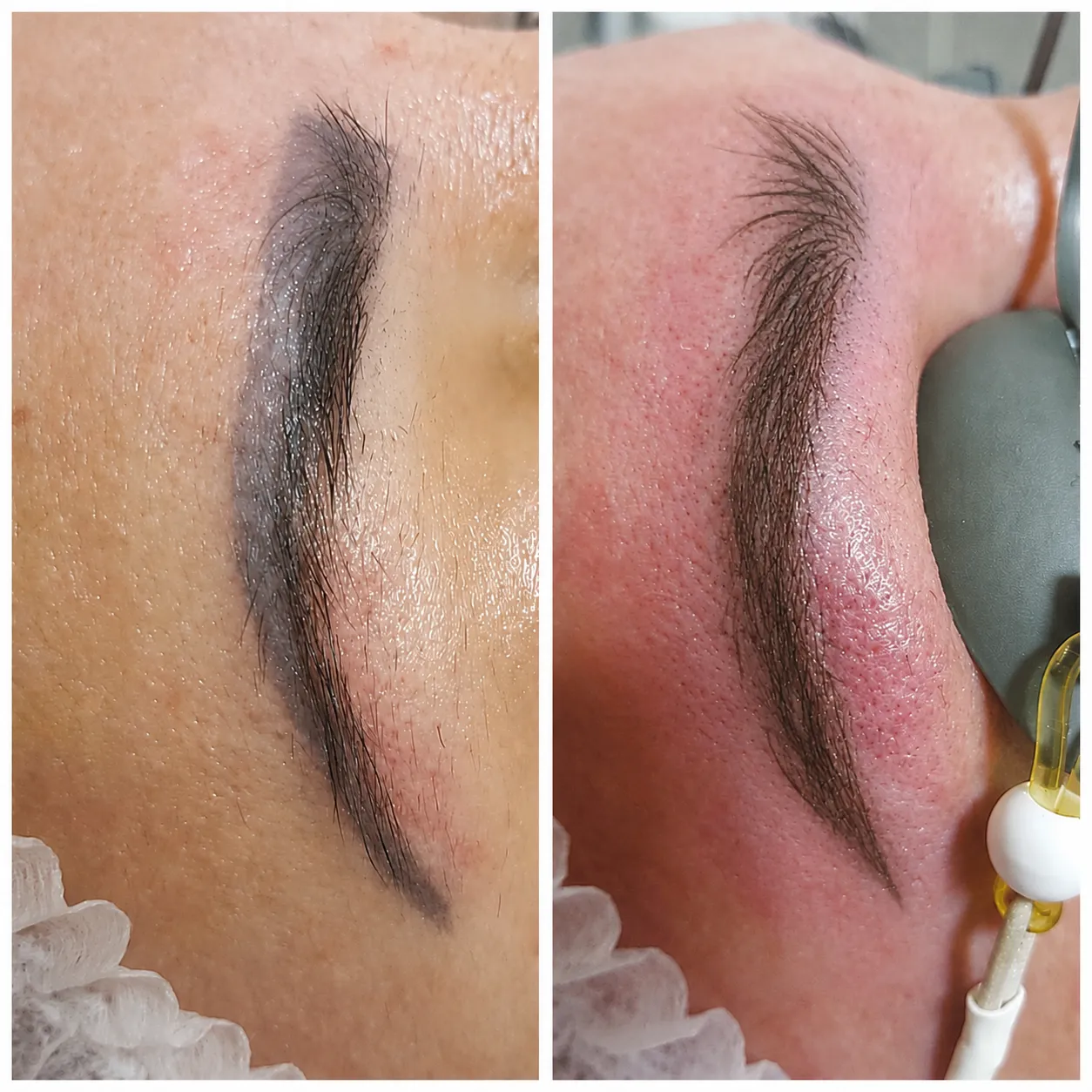 antes e depois de despigmentação de sobrancelha escura
