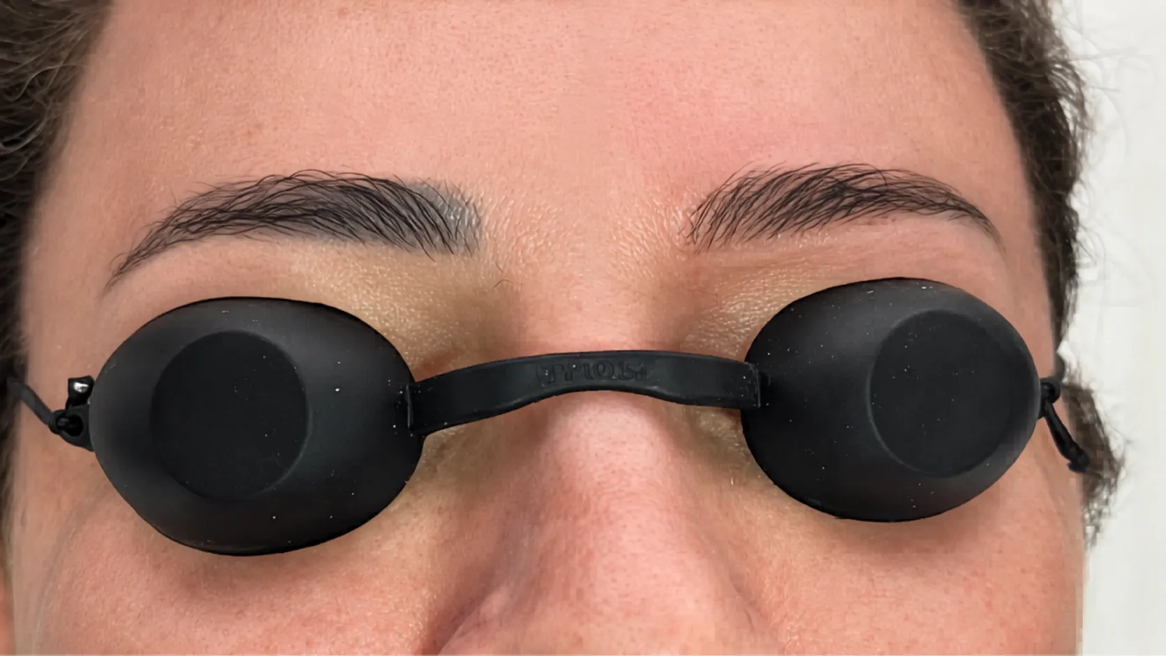 Cliente com óculos de proteção durante a sessão de remoção de micropigmentação